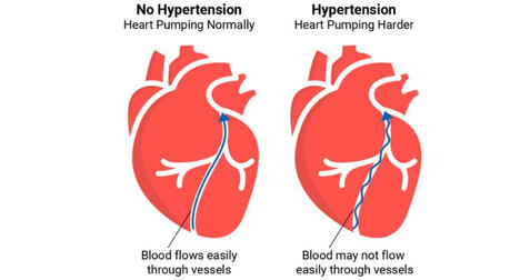 Empowering Your Health: Strategies for Effective Hypertension Management