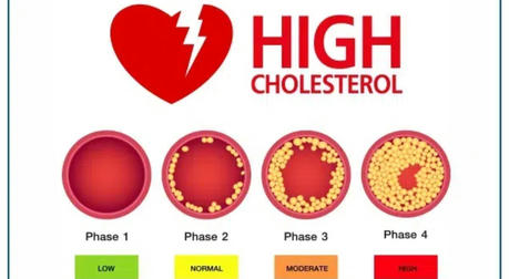 Understanding Cholesterol: A Comprehensive Guide to Risk Factors and Lifestyle Changes