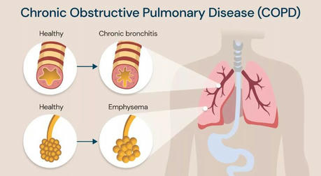 Understanding Chronic Obstructive Pulmonary Disease (COPD): Challenges and Opportunities in Management